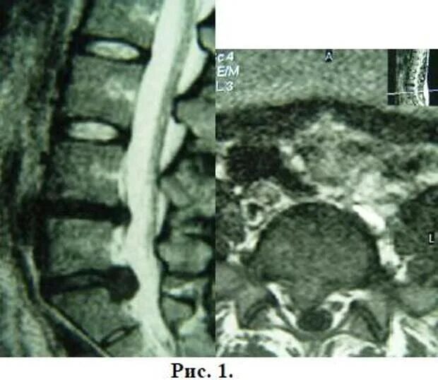 Протрузия дисков на уровне l4 l5. Протрузия l5 на мрт. Грыжа 8 мм l5-s1. Межпозвоночные диски l5 l6. Межпозвонковый спондилоартроз сегментов l1-l2 l2-l3 l3-l4 l4-l5.