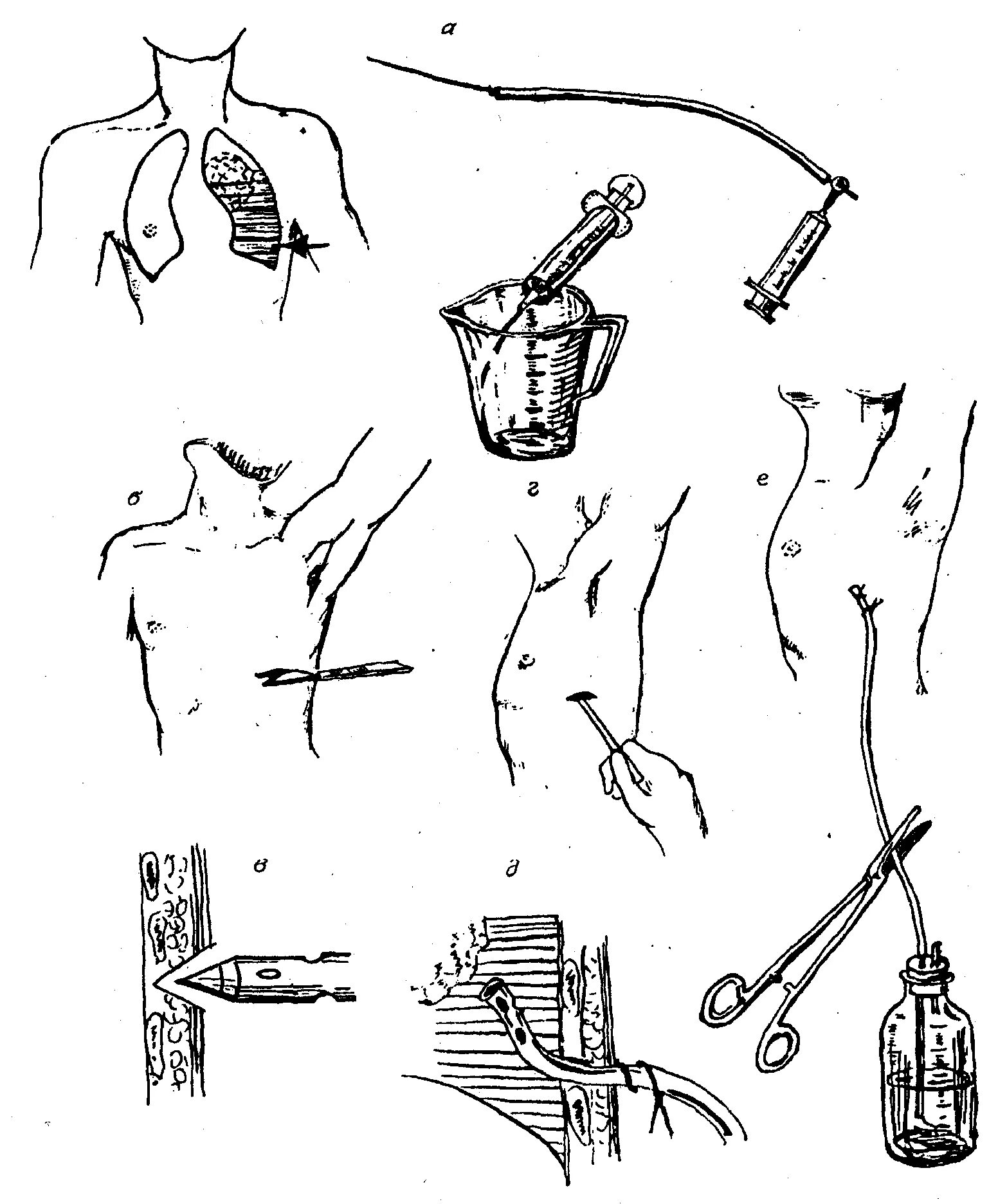 Пунция. Пневмоторакс дренирование плевральной. Пневмоторакс дренирование плевральной полости. Техника дренирования плевральной полости при травмах грудной клетки. Дренирование плевральной полости алгоритм.