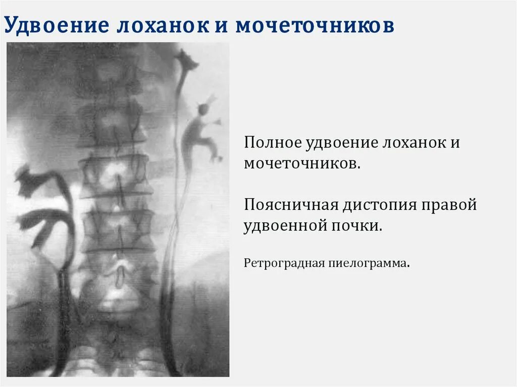 Два мочеточника. Неполное удвоение почки рентген. Урография удвоение мочеточника. Неполное удвоение мочеточника кт. Удвоение чашечно-лоханочной системы почек кт.