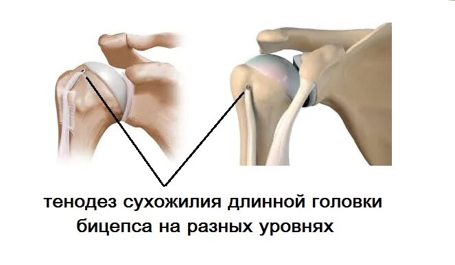 Тенодез сухожилия длинной головки двуглавой мышцы плеча. Операция на плечевом суставе разрыв сухожилия. Тенодез сухожилия бицепса плечевого сустава. Разрыв проксимального сухожилия двуглавой мышцы плеча.