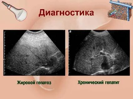 Узи диагностика печени