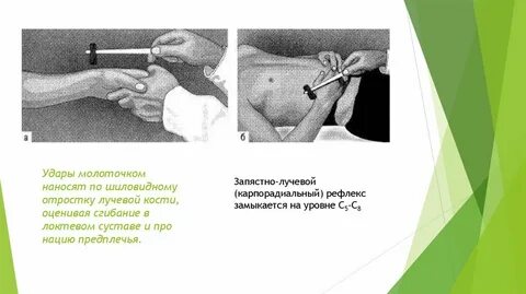 Рефлекс молоточком