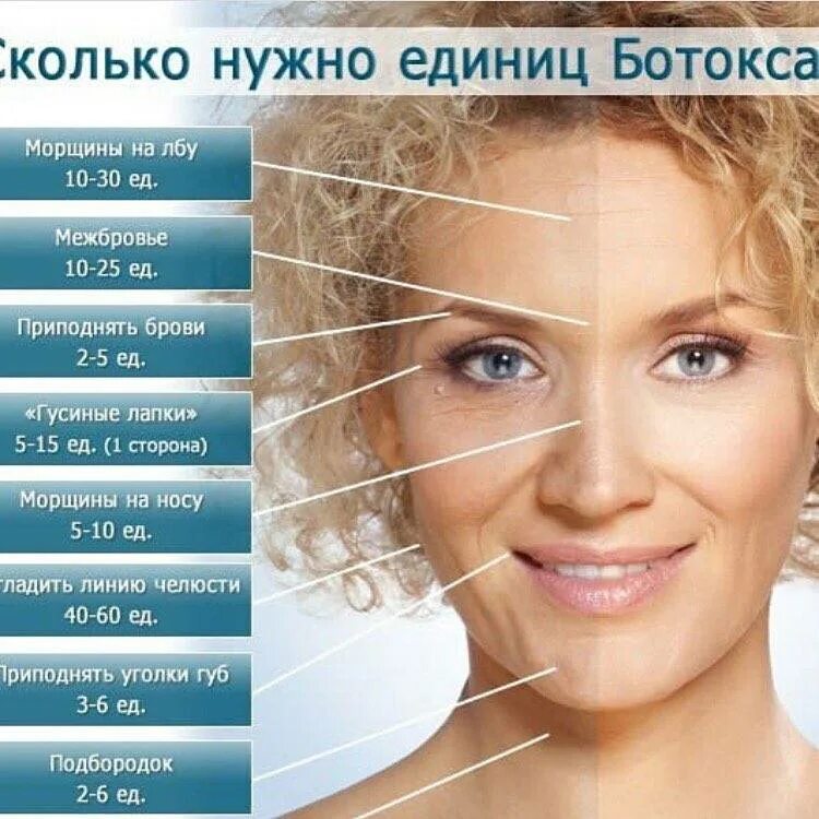 Сколько ботокса нужно в лоб. Сколько единиц ботокса нужно. сколько единиц ботокса надо на лоб. сколько единиц нужно на лоб ботокс.