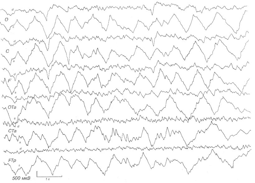 Ээг 3 лет. ЭЭГ кардиограмма аутиста. Энцефалит на ЭЭГ. Миттенс ЭЭГ. Герпетический энцефалит на ЭЭГ.