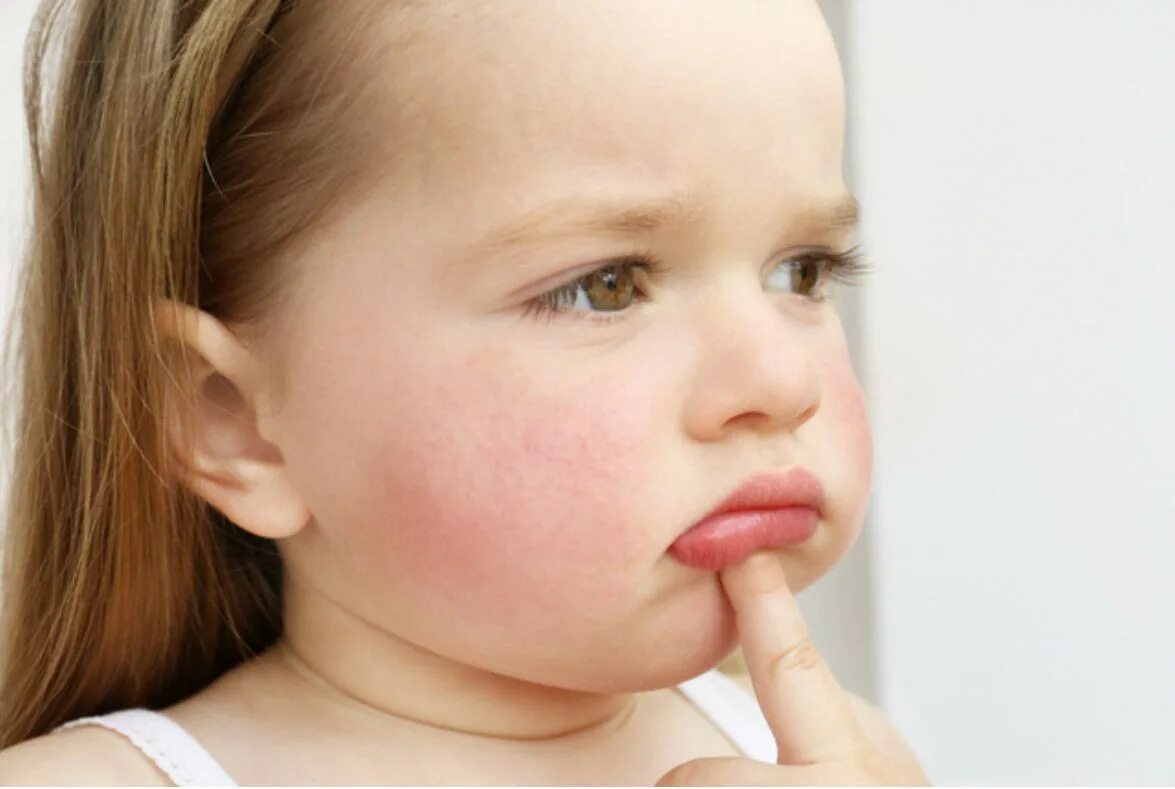Атопич. Атопический дерматит у детей.