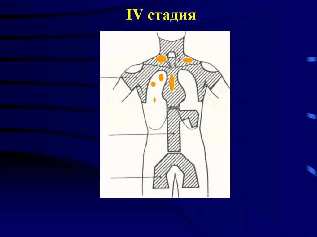 Акубаротравма