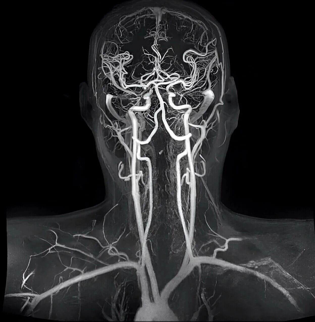 Венография головного мозга. Кт ангиография брахиоцефальных артерий. Мрт ангиография артерий головного мозга. МР-ангиография сосудов головного мозга. Компьютерно-томографическая ангиография сосудов головного мозга.