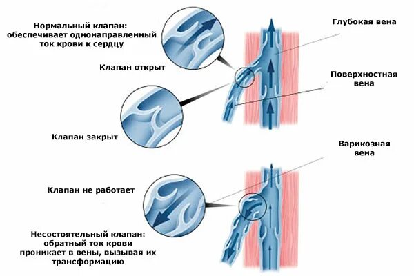 Строение вен нижних конечностей клапаны. Вены ног клапаны