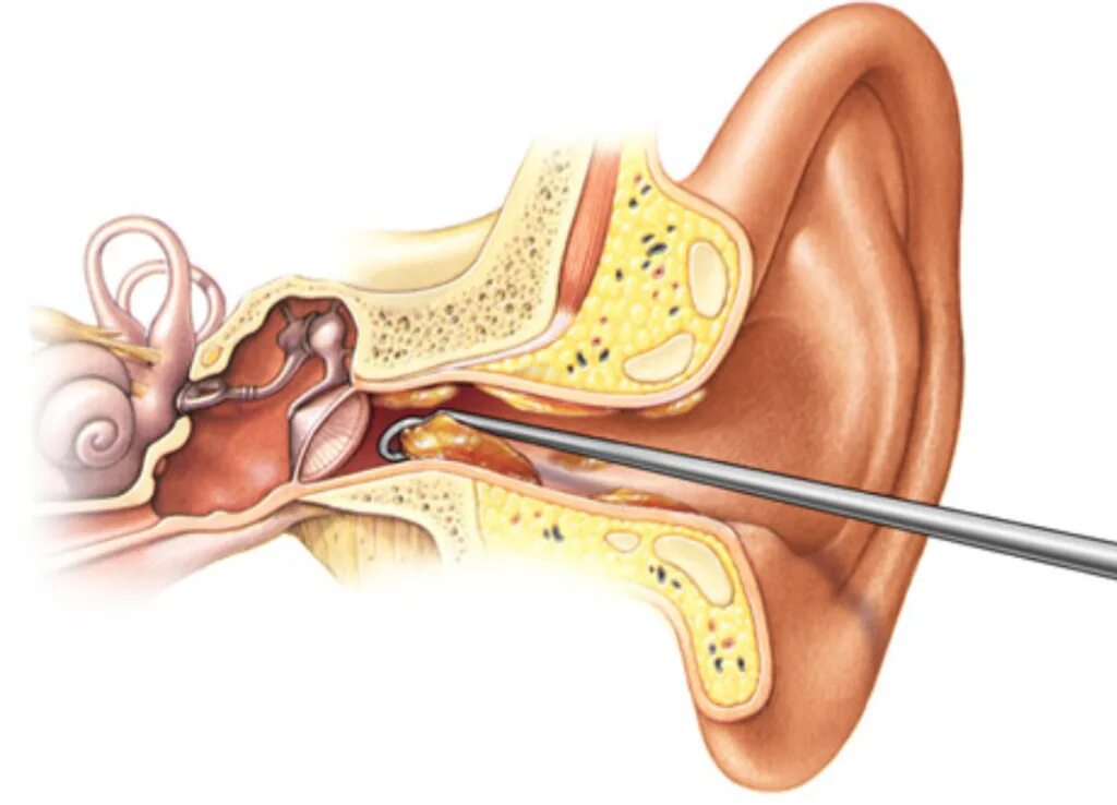 Ухо заложило после чистки палочкой. Отомикоз серная пробка.