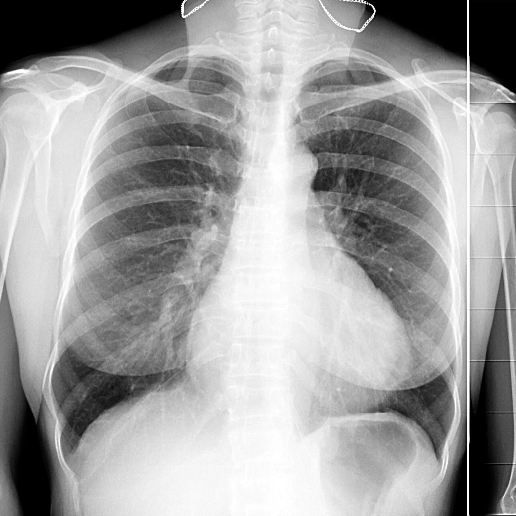 Флотирующий перелом ребер рентген. Перелом левого ребра снимок. Многооскольчатый перелом ребра. Перелом грудной клетки рентген. Сломала два ребра.