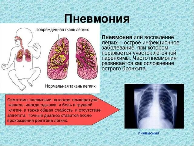 Пневмония поражение легких. Заболевание легких пневмония. Коронавирус без кашля