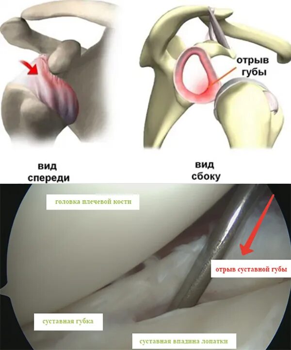 Повреждение губы плечевого сустава. Операция Банкарта и Хилл-Сакса. Артроскопическая операция Банкарта плечевого сустава. Банкарта плечевого сустава кт. Банкарт повреждение плечевого сустава.