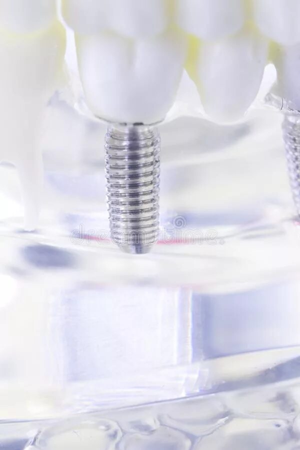 Titanium implants
