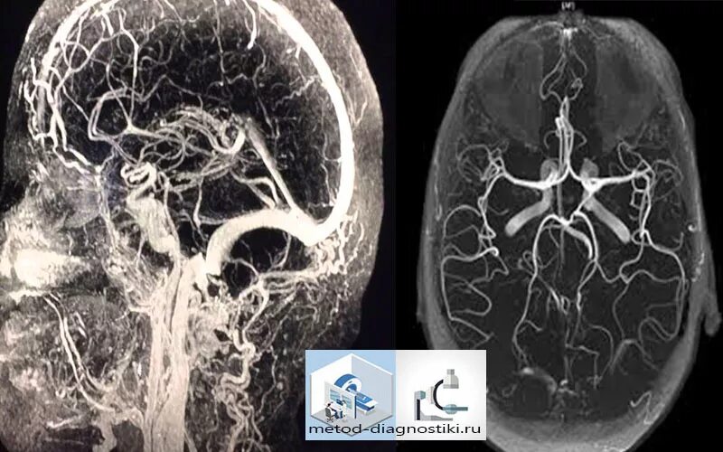 Ангиография сосудов головного мозга. Мрт ангиография сосудов головного мозга. Мрт головного мозга с ангиографией. Мрт сосудов головного мозга (мрт-ангиография). Разница кт и кт с контрастом
