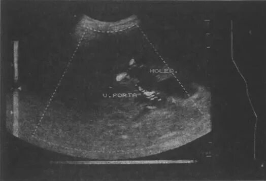 аденоматозный полип желчного пузыря на узи. полип стенки желчного пузыря. желчекаменная болезнь узи. полип желчного пузыря на узи. полип желчного пузыря на узи.