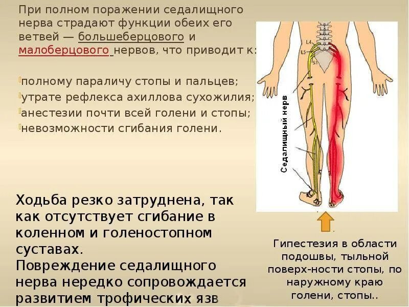 Колет в задний. Седалищный нерв схема расположения. Поражение седалищного нерва. Защемление седалищного нерва. Защемление седалищного нерва симптомы.