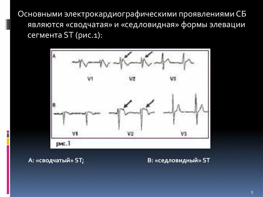 Эпизод депрессии сегмента st. Седловидная элевация сегмента st. норма элевации сегмента st. элевация сегмента st бругада. эпизоды элевации сегмента st на холтере.