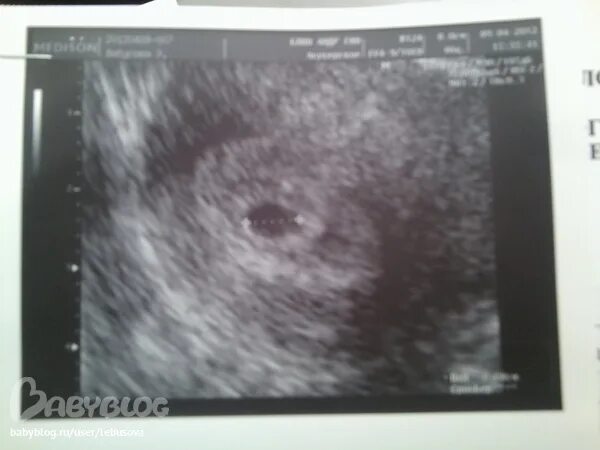 узи 2 месяца беременности. узи 2 месяца беременности. узи плода на 10 неделе беременности. узи на 3 месяце беременности. снимок узи беременности 4 месяца.