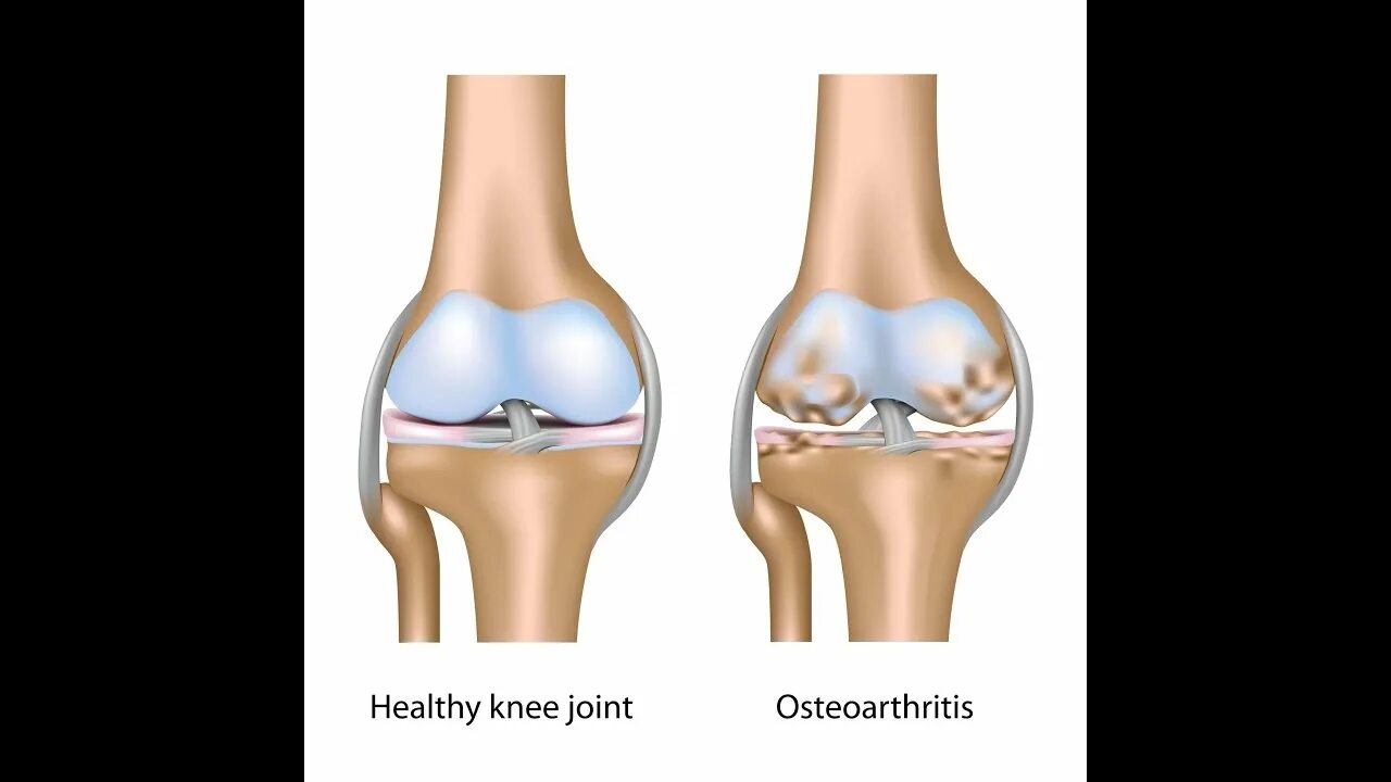 Остеоартрит коленного сустава. Заболевания суставов артриты и артрозы. Разница между артритом и артрозом. Артроз коленного сустава название
