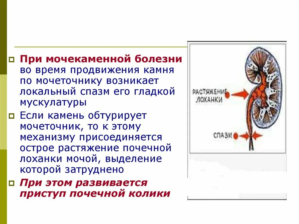 Мочекаменная болезнь пропедевтика. Мочекаменная болезнь механизм. Мочекаменная болезнь этиология. Мочекаменная болезнь мочеточника.