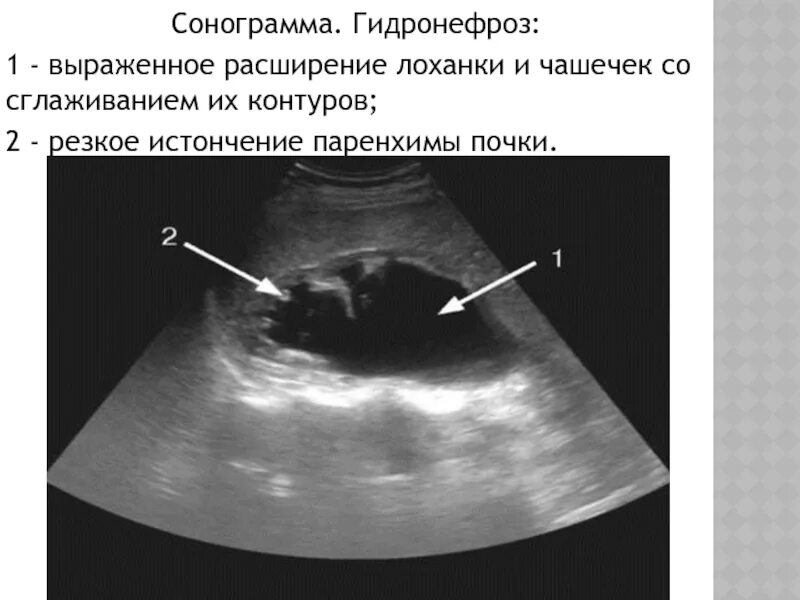 Расширенная члс. Расширение лоханки почки на УЗИ. Расширенная лоханка почки на УЗИ. Расширение почечной лоханки на УЗИ. Расширенная почечная лоханка на УЗИ.