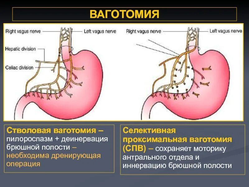 Хирургические заболевания желудка. Ваготомия желудка проксимальная. Ваготомия с дренирующими желудок операциями. Ваготомия при язвенной болезни. Ваготомия желудка при язвенной болезни.