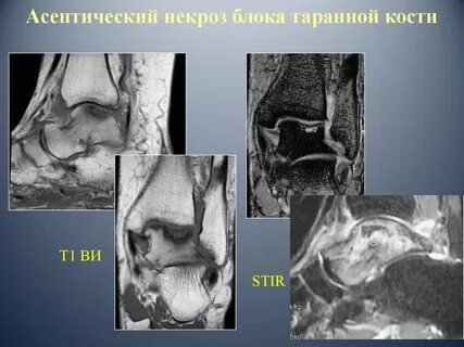 Аваскулярный некроз