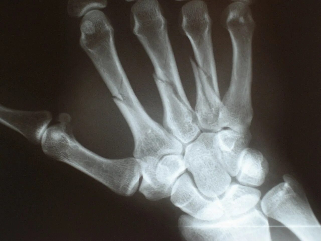 Рентген передома пояснойкости. Перелом пястной кости рентген. Рентген кисти перелом пястной кости. Перелом 2 пястной кости.