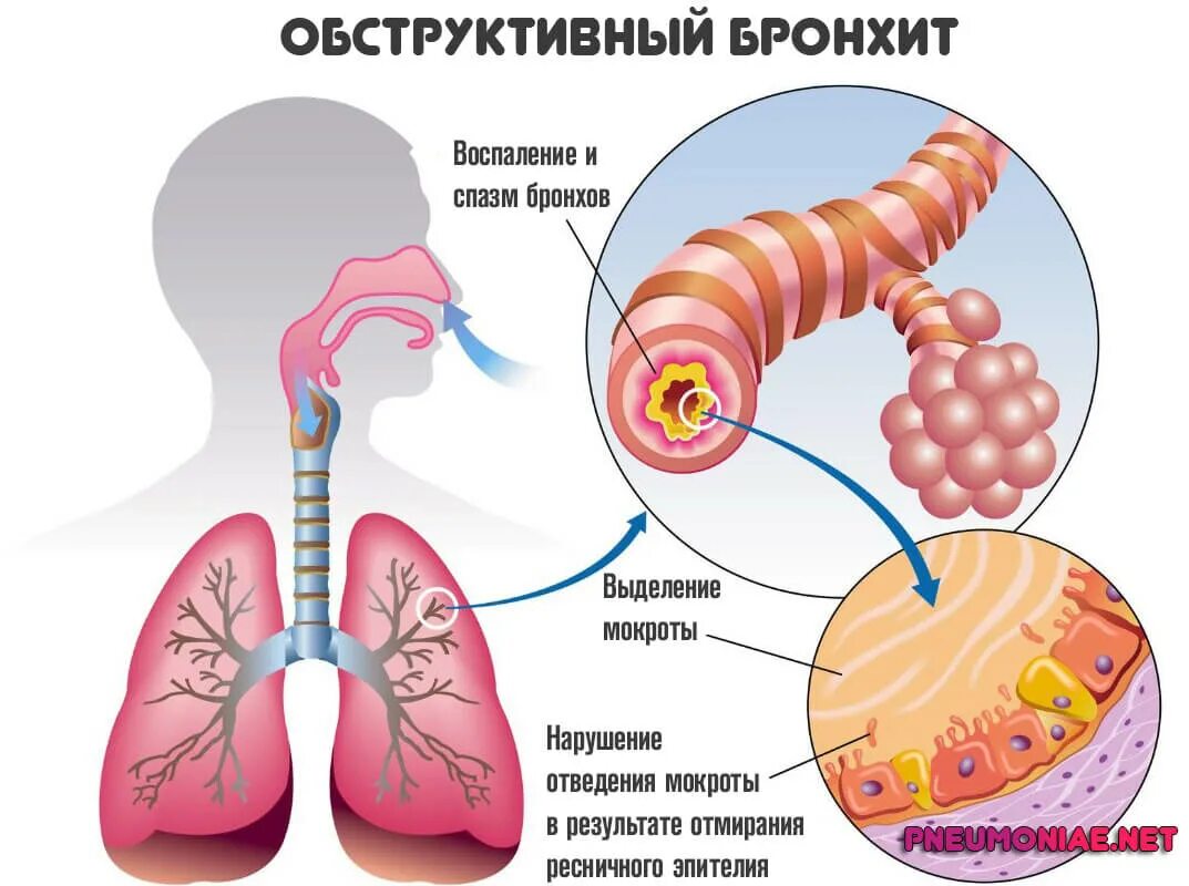 Почему у ребенка мокрота