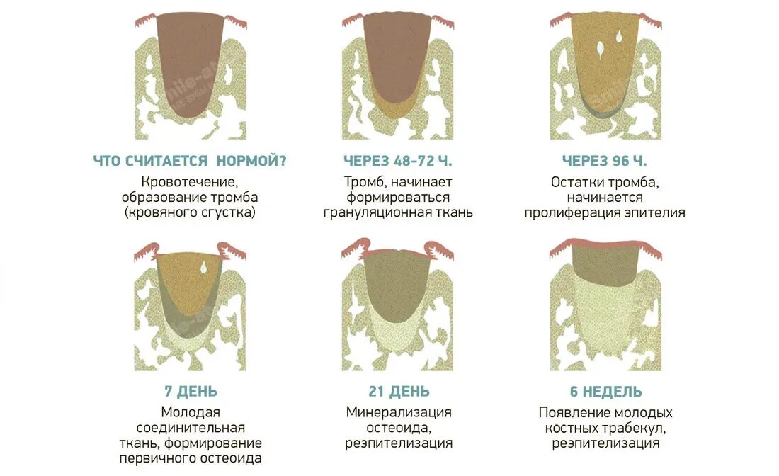 Можно ли купаться после удаления зуба. Стадии заживления лунки удаленного зуба. лунка послеудалегия зуба мудрости. этапы заживления лунки зуба.