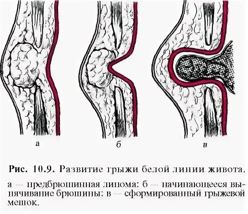 Как быстро растет грыжа. Послеоперационная вентральная грыжа. эпигастральная грыжа белой линии живота. эпигастральная вентральная грыжа. вентральная грыжа живота.