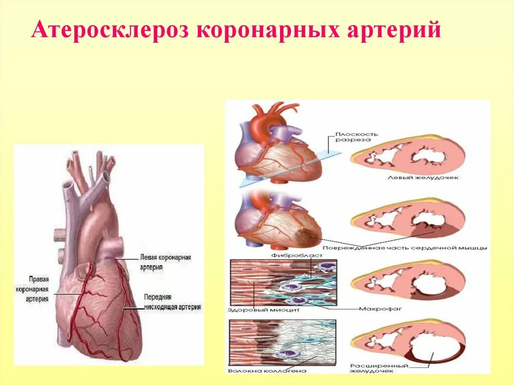 Атеросклероз левого желудочка. Атеросклероз коронарных артерий. атеросклероз коронарных артерий сердца. коронарный атеросклероз. профилактика атеросклероза коронарных артерий.