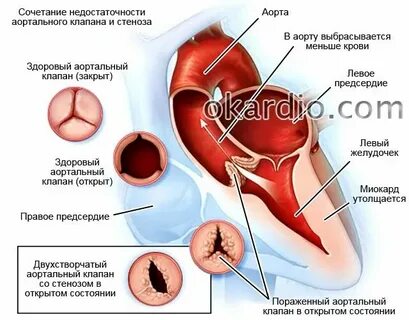 Уплотнение стенок почек
