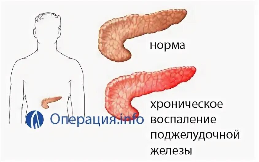 Поджелудочная железа операция. Панкреатит операция поджелудочной. Операция на поджелудочную железу. Операция на поджелудочной железе при панкреатите. Панкреатит операцию делают