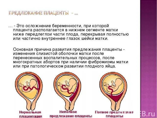 Предлежание плаценты: виды и симптомы, что делать и чем грозит, профилактика