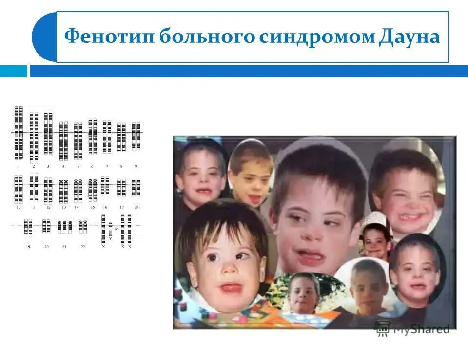 Синдром дауна трисомия по 21-й хромосоме. Синдром дауна (трисомия 21-й хромосомы). Синдром дауна тип наследования. Геномные мутации болезни. Изменение дозы генов при хромосомных заболеваниях.