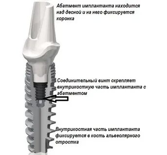 Почему болят импланты