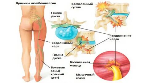 Боль в спине области поясницы - Quara.ru