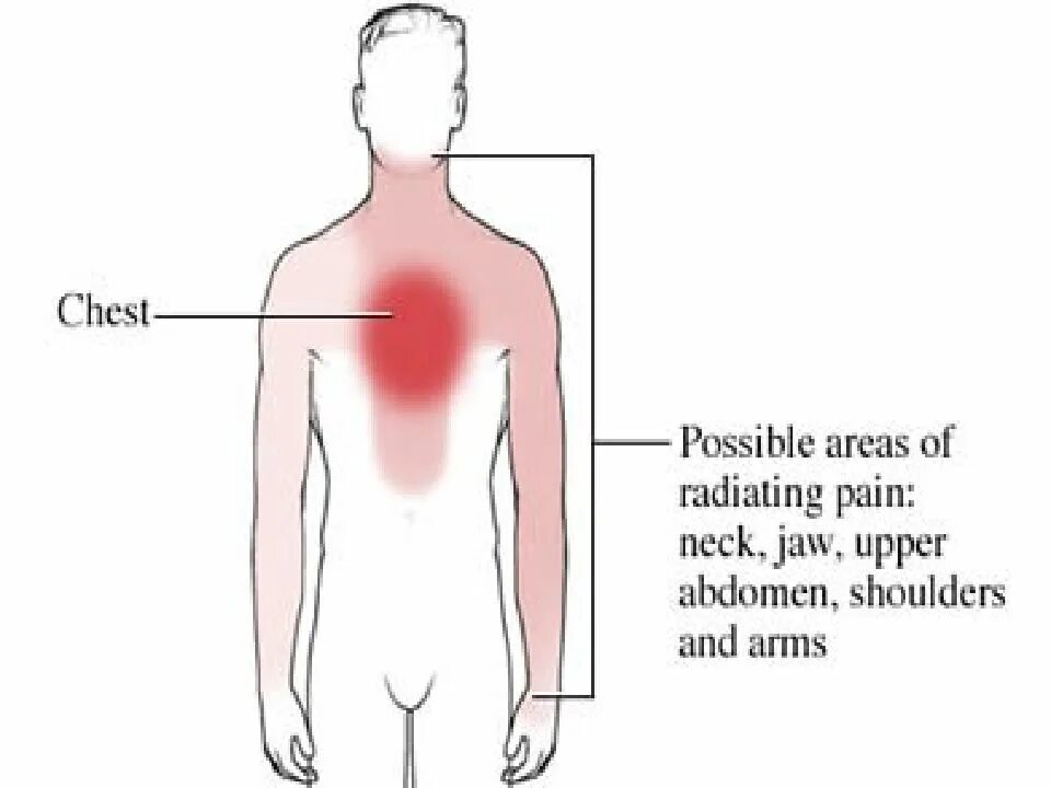 От чего может болеть грудная клетка. Локализация боли в грудине. Боль при стенокардии. Локализация стенокардии. Стенокардия иррадиация болей.