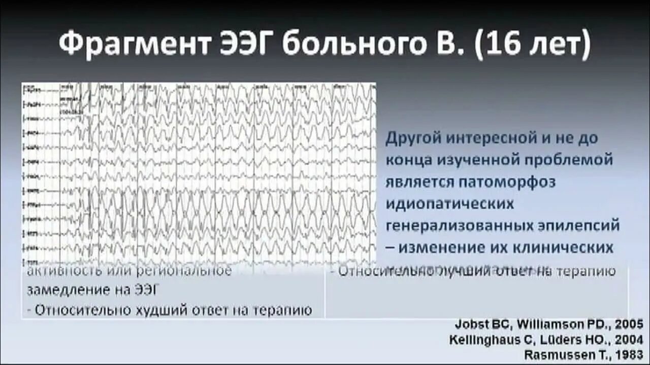 Идиопатическая генерализованная эпилепсия. Генерализованная эпилепсия ЭЭГ. ЭЭГ при эпилепсии. Заключение ЭЭГ при эпилепсии. ЭЭГ здорового человека.