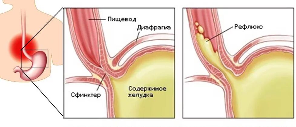 Эзофагит рефлюкс кислотный. Гастроэзофагеальный (желудочно-пищеводный) рефлюкс. Гастроэзофагеальный рефлюкс у новорожденного. Почему сфинктер