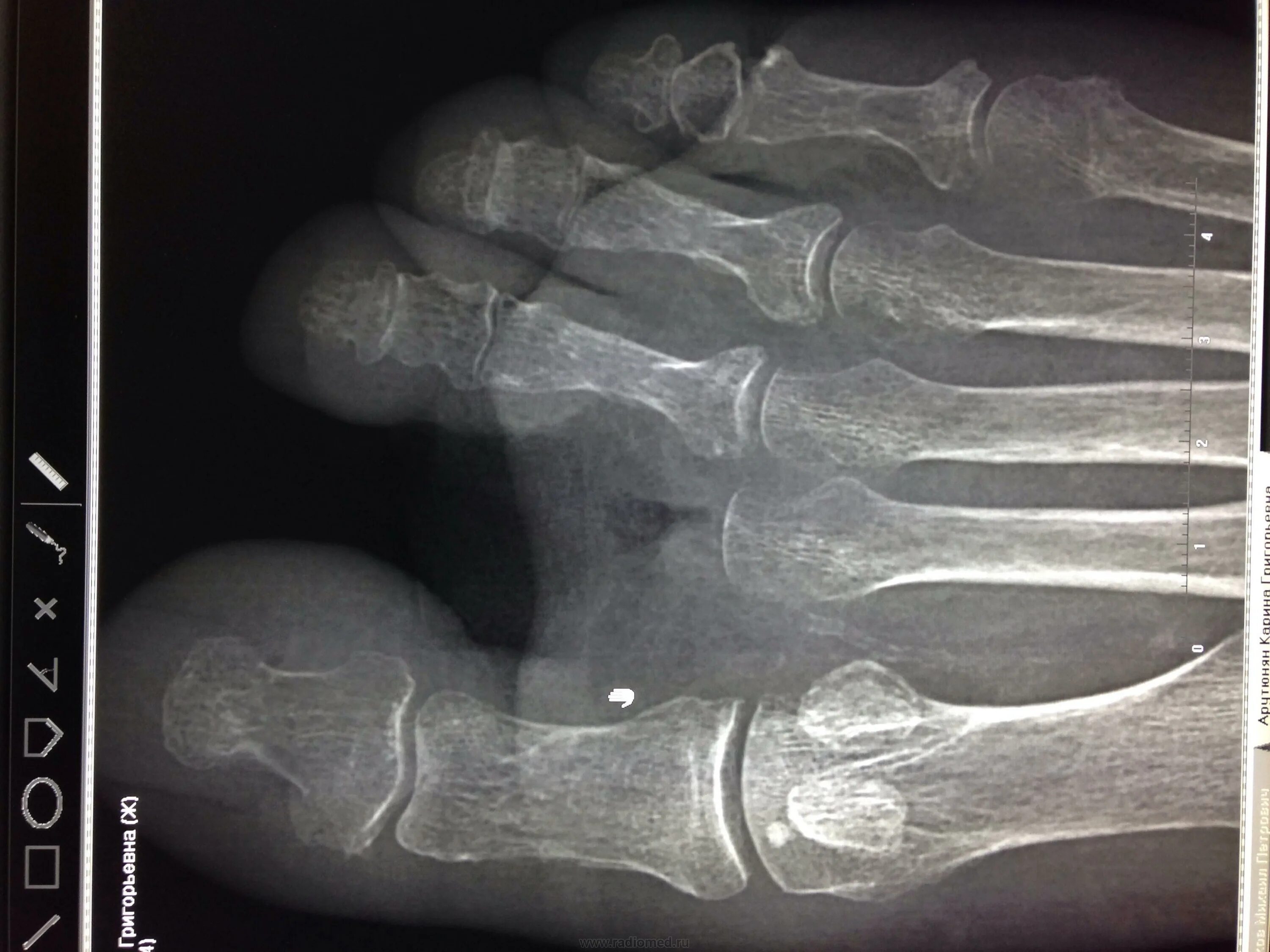 Краевой перелом фаланги рентген. Перелом основной фаланги 5 пальца ноги рентген. Краевой перелом ногтевой фаланги. Эпифизеолиз фаланги пальца. Ногтевая фаланга ноги