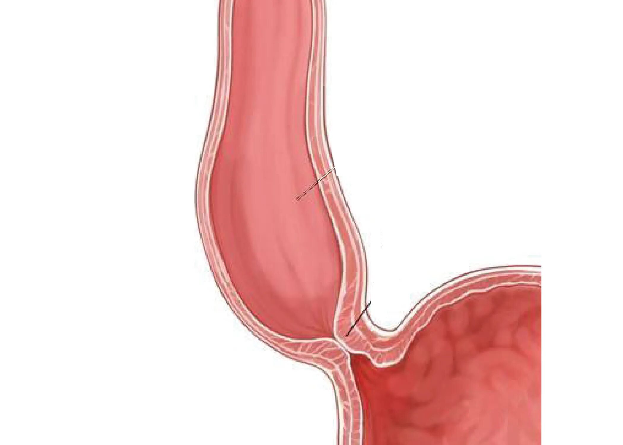 Ахалазия кардии 3 степени. Кардия 2 степени. Кардия 2 степени. Ахалазия пищевода рентген степени. Ахалазия пищевода на рентгенограмме.