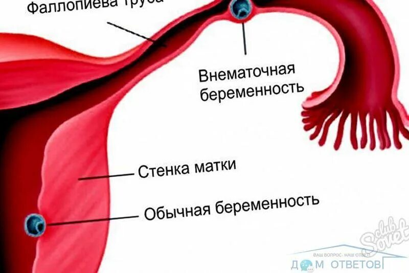 Удалили трубу можно ли забеременеть. Внематочная беременность. Удаление маточной трубы. Внематочная Трубная беременность. Вырезать фалопиевые трубы.