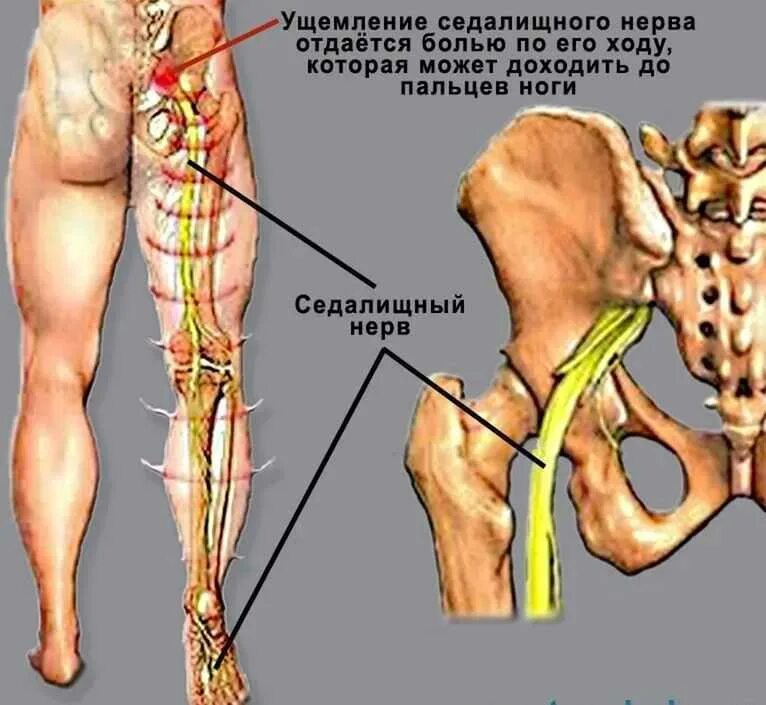 Боль в пояснице седалищный нерв лечение. Анатомия седалищного нерва у человека. Седалищный нерв схема. Где находится седалищный нерв у человека фото. Седалищный и бедренный нерв.