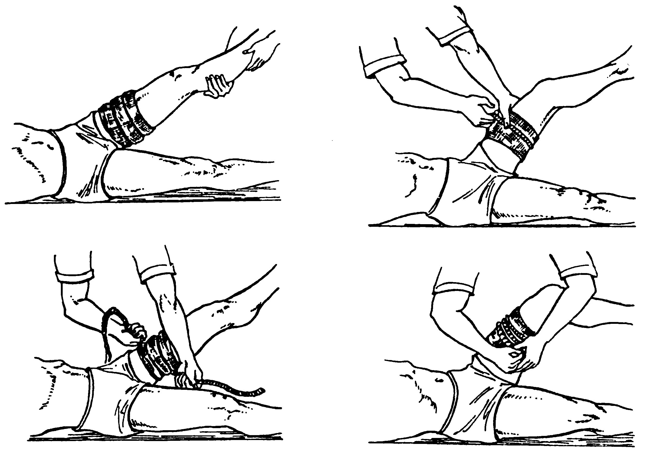 Технику наложения кровоостанавливающего жгута на бедро.. Техника наложения кровоостанавливающего жгута. Наложение кровоостанавливающего жгута на конечность. Техника наложения кровоостанавливающего жгута алгоритм. Алгоритм наложения жгута при артериальном кровотечении