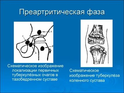 Фазы костно суставного туберкулеза