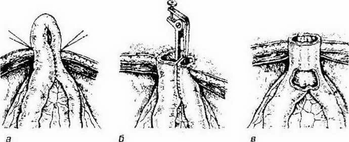 Дренирующие операция по гейнеке-микуличу. Резекция по типу микулича. Операция гейнеке микуличу. Эвентрация петель толстого кишечника. Пилоропластика по джадду, джабулею, микуличу.