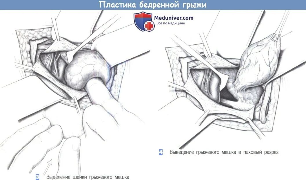Операция по бассини при бедренной грыже. Бедренная грыжа операция по бассини. Операция бассини при бедренных грыжах. Операция бассини при бедренных грыжах. Бедренная грыжа операция по бассини.