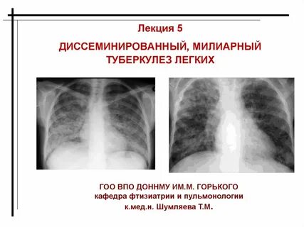 Диссеминированный кавернозный туберкулез